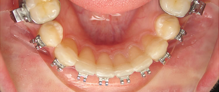 fast splint matrix