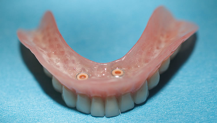 fiber force denture